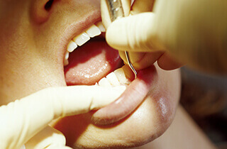 【4】歯周病検査