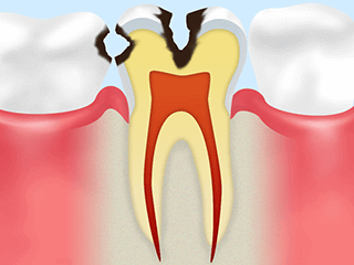象牙質の虫歯（C2）
