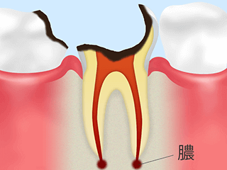 歯の根の虫歯（C4）