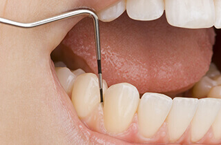 歯周ポケット検査・歯の動揺度検査